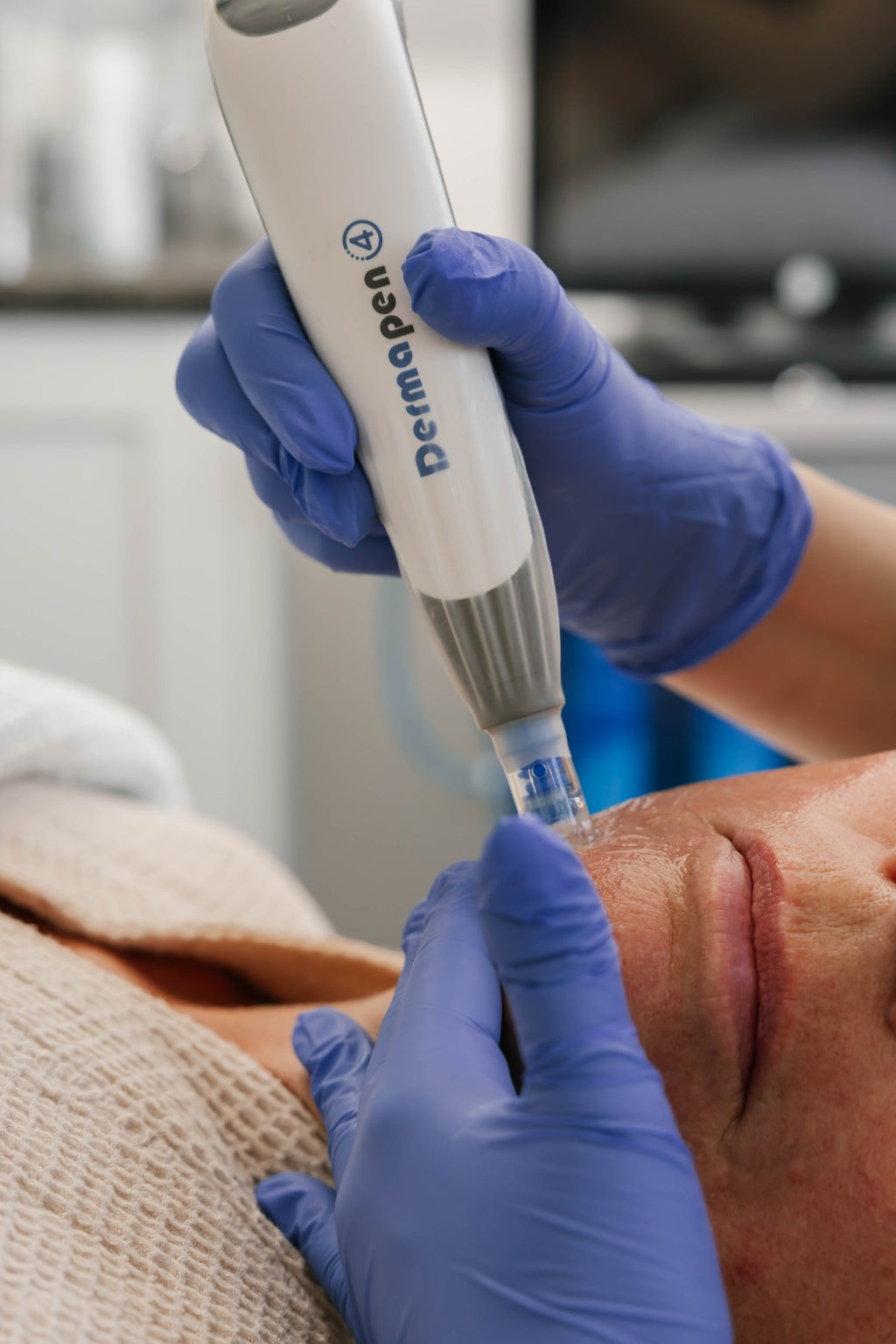Microneedling with VAMP Package